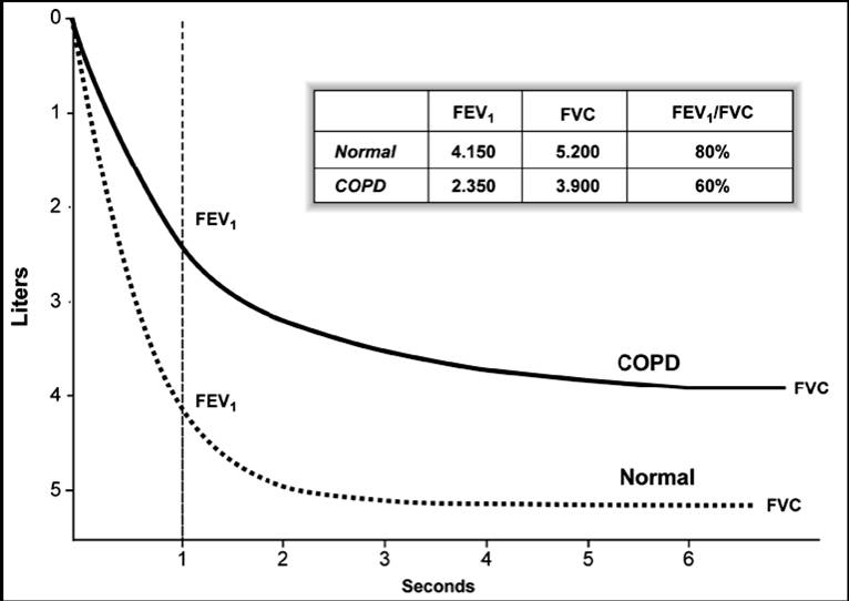 What can your spirometry results tell you about your health?