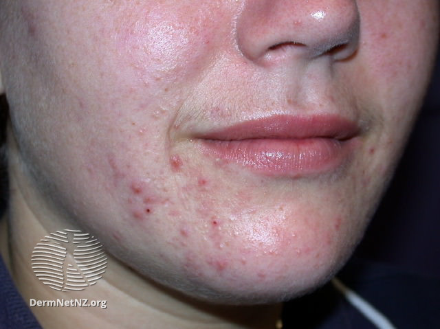 Image 4 papulo-pustular-acne