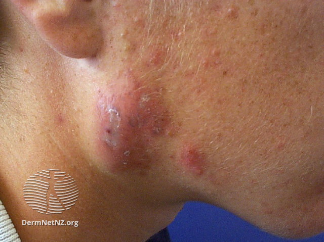 Nodulo cystic acne