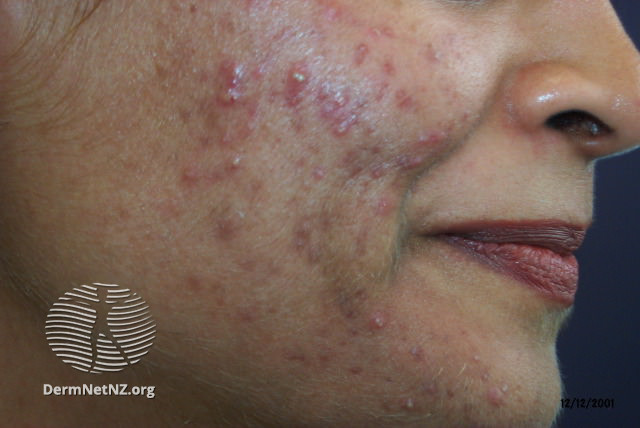 mild acne vulgaris