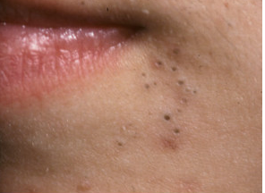 mild comedonal acne