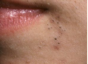 mild acne vulgaris