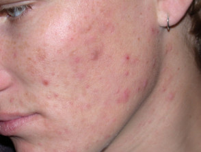 papulo pustular acne