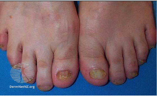 Antibiotics for an ingrown toenail? - Ingrown Toenail Clinics