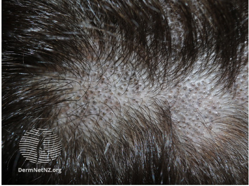 Tinea capitis (scalp ringworm) 