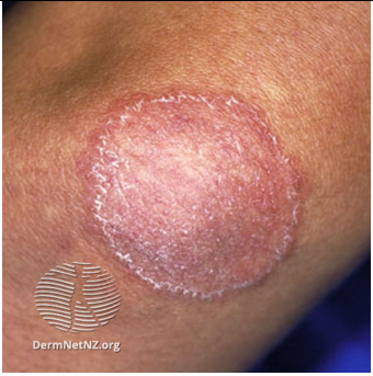 tinea-corporis-image2png tinea-corporis-image2png