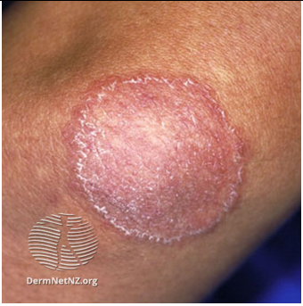 tinea-corporis-image2png