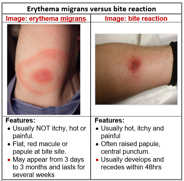 Lyme Disease Antibiotic Prescribing Hse Ie