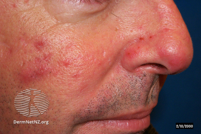 Papulopustular rosacea