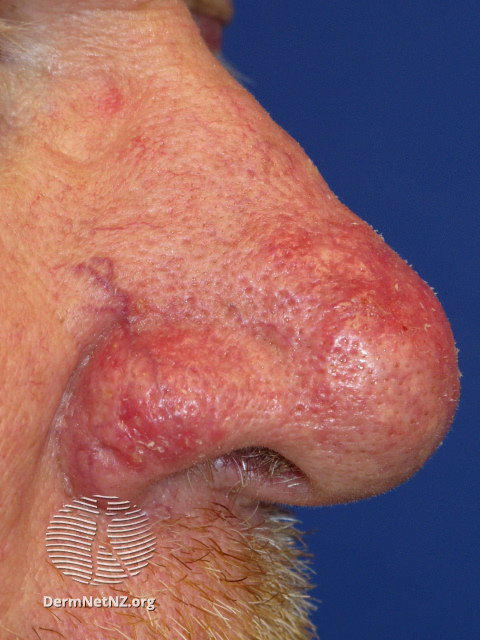 Telangiectasia with early rhinopyhma