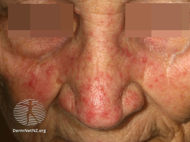 Telangiectasia example