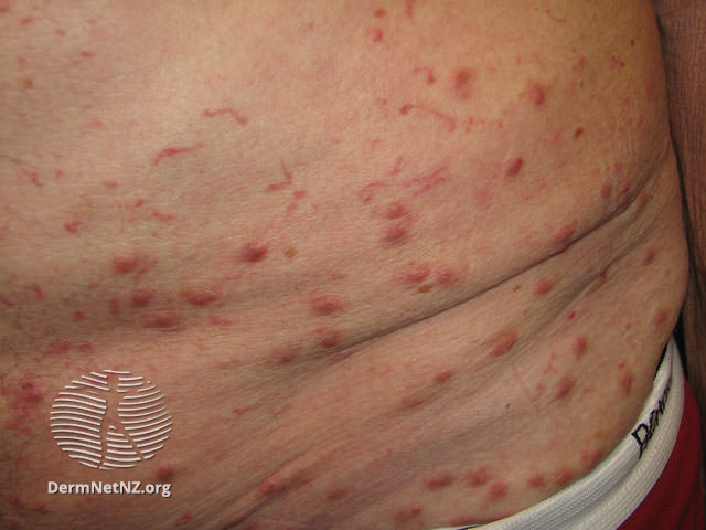 Scabies top treatment lotion