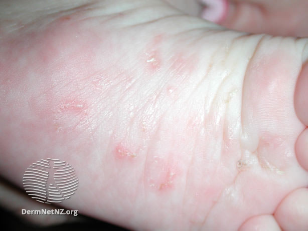 Scabies-image-2