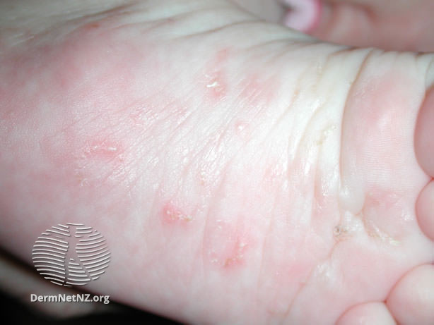 Scabies: Diagnosis and Treatment with Images - DermNet